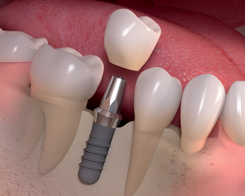 Dental Implants