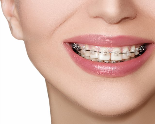 Benefits of Invisalign